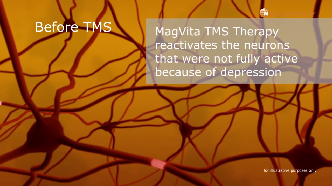 TMS for depression treatment