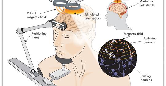 JAMA : Brain Stimulation Approved for Obsessive-Compulsive Disorder